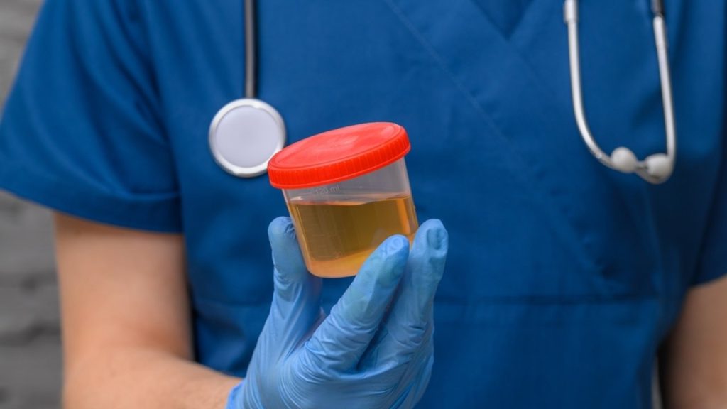 Ilustračná fotografia: Vzorka moču môže obsahovať fragmenty DNA uvoľnené nádorom. Nový test dokázal v klinickej štúdii zachytiť viac ako deväť z desiatich prípadov rakoviny močového mechúra. Foto: PawelKacperek / Shutterstock