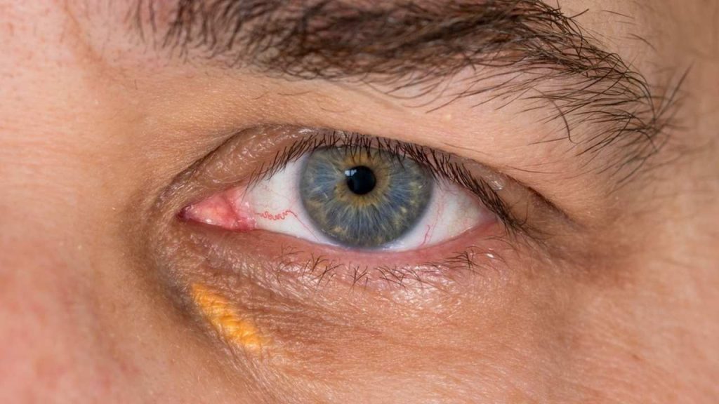 Ilustračná fotografia: Xantelazmy sú žltkasté ložiská tuku, ktoré sa najčastejšie objavujú v okolí očí. Nový výskum ich spája s vyšším rizikom infarktu a mozgovej príhody. Foto: Muhlbach / Shutterstock